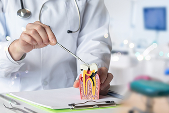 How to Take Care of Your Teeth After a Root Canal
