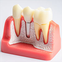 Dental Implants in Kukatpally