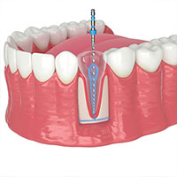 Root Canal Treatment in Kukatpally