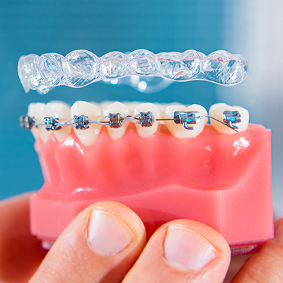 Braces / Invisalign